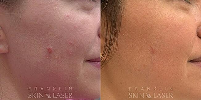 Mole Removal Before & After Image