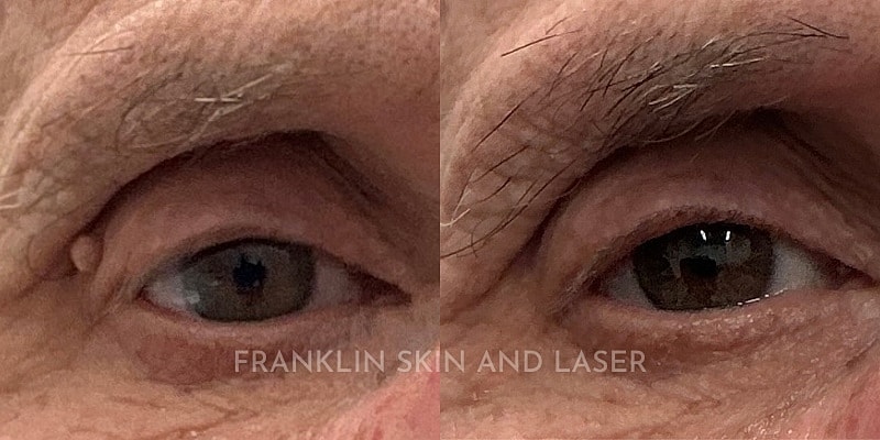 Mole Removal Before & After Image