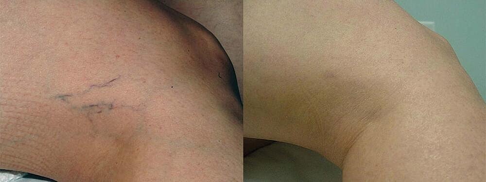 Laser Vein Reduction Before & After Image