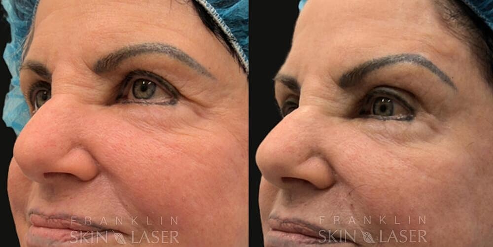 Thread Lift Before & After Image