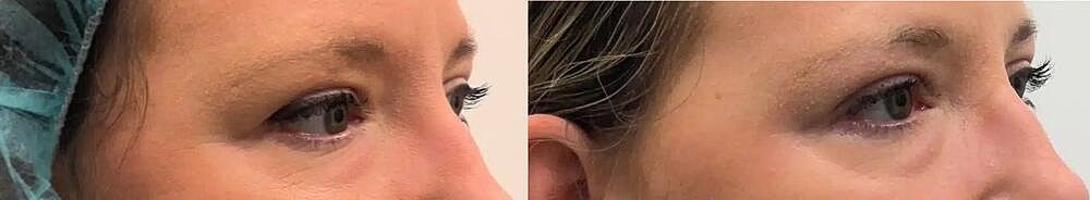 Plasma Pen Before & After Image
