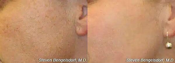 Photorejuvenation Before & After