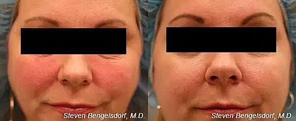 Photorejuvenation Before & After