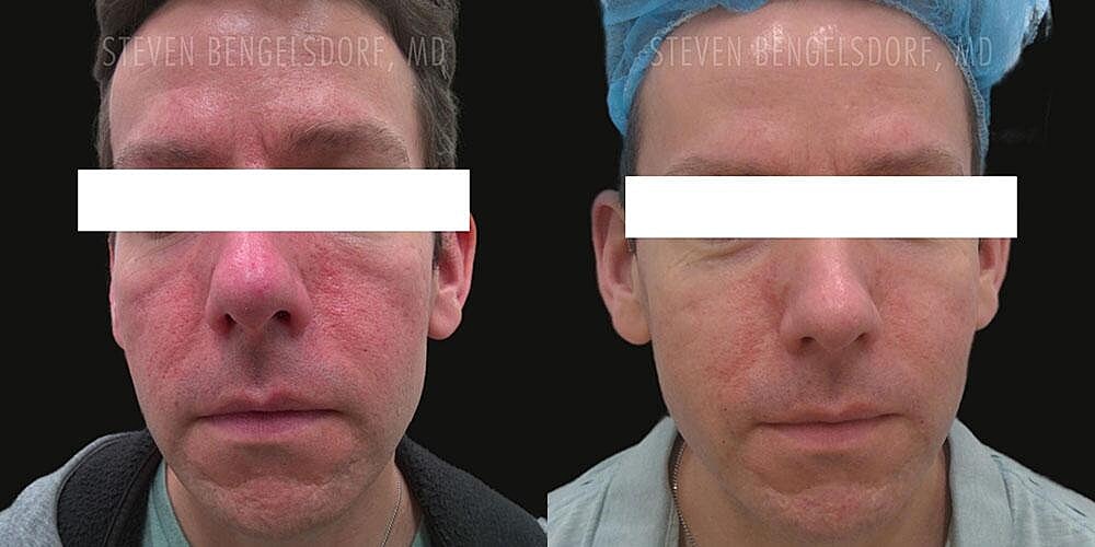 Photorejuvenation Before & After