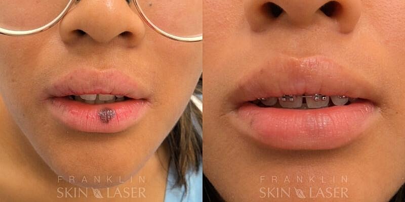 Photorejuvenation Before & After