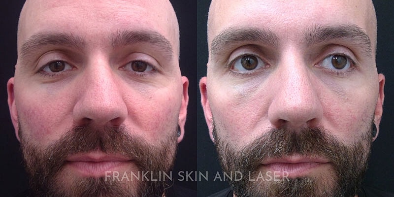 Photorejuvenation Before & After