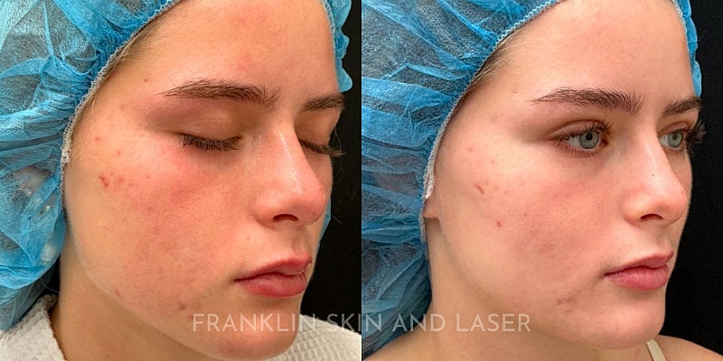 Photorejuvenation Before & After