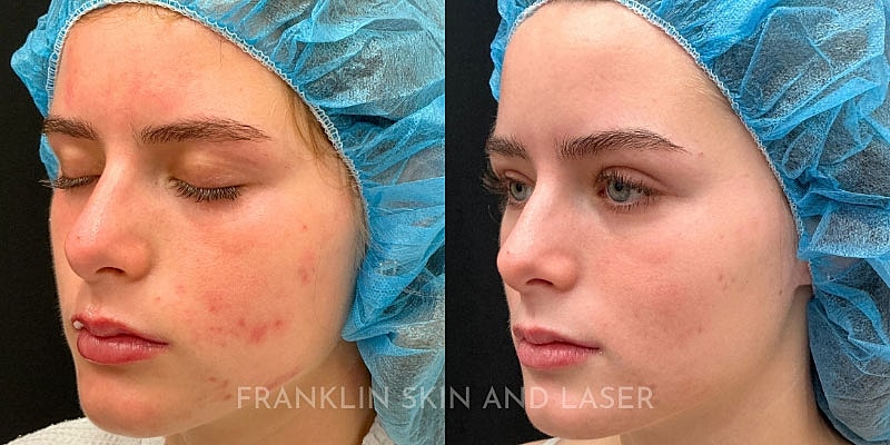 Photorejuvenation Before & After