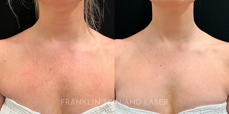 Photorejuvenation Before & After