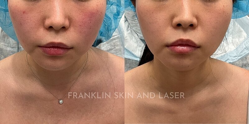 Photorejuvenation Before & After