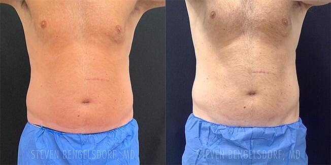 Emsculpt NEO Before & After Image