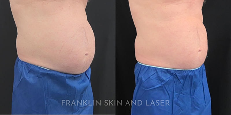 Emsculpt NEO Before & After Image