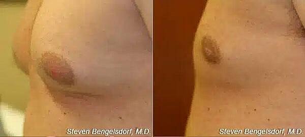 Gynecomastia Before & After Image