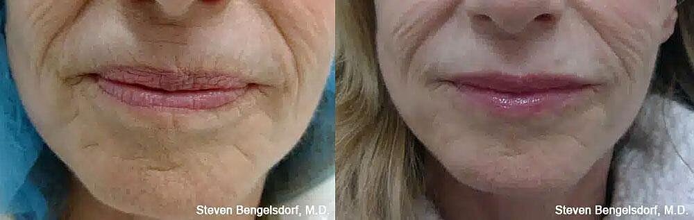 Lower Face Filler Before & After Image