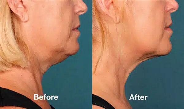 Kybella Before & After