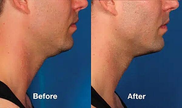 Kybella Before & After