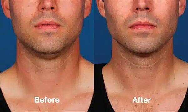 Kybella Before & After