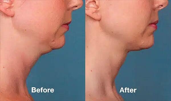Kybella Before & After