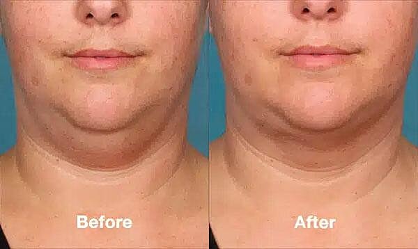 Kybella Before & After
