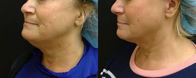 Kybella Before & After