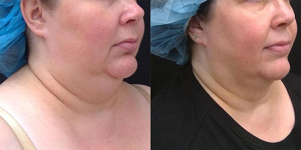 Kybella Before & After