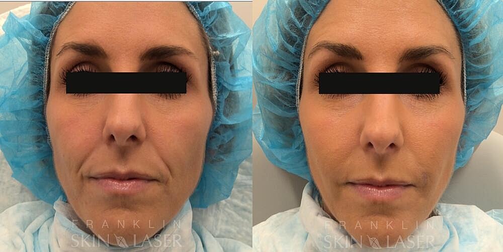 Mid Face Filler Before & After