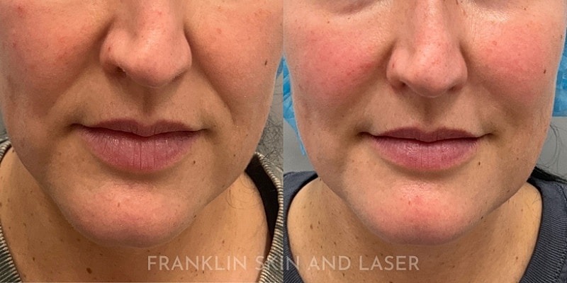 Mid Face Filler Before & After