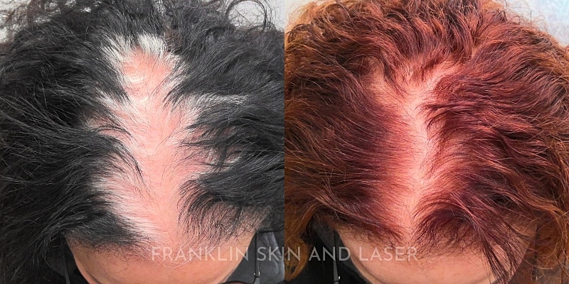 Hair Restoration Before & After Image