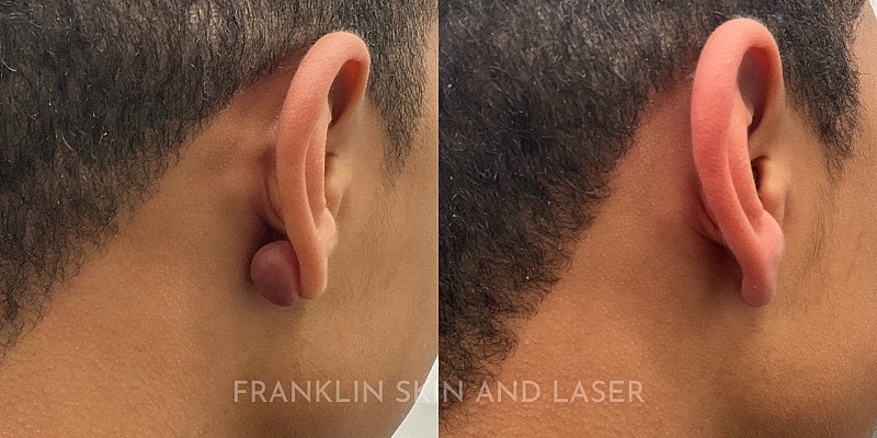 Keloid Removal Before & After Image
