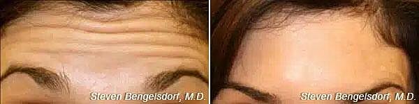 Neuromodulators Before & After