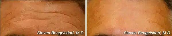 Neuromodulators Before & After