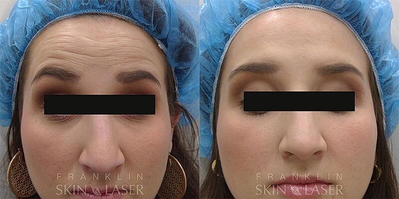 Neuromodulators Before & After