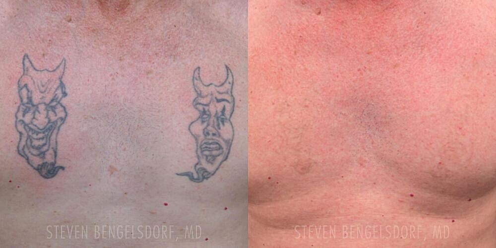 Tattoo Removal Before & After Image