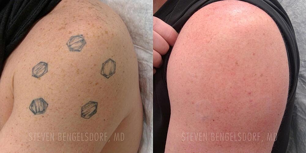 Tattoo Removal Before & After Image