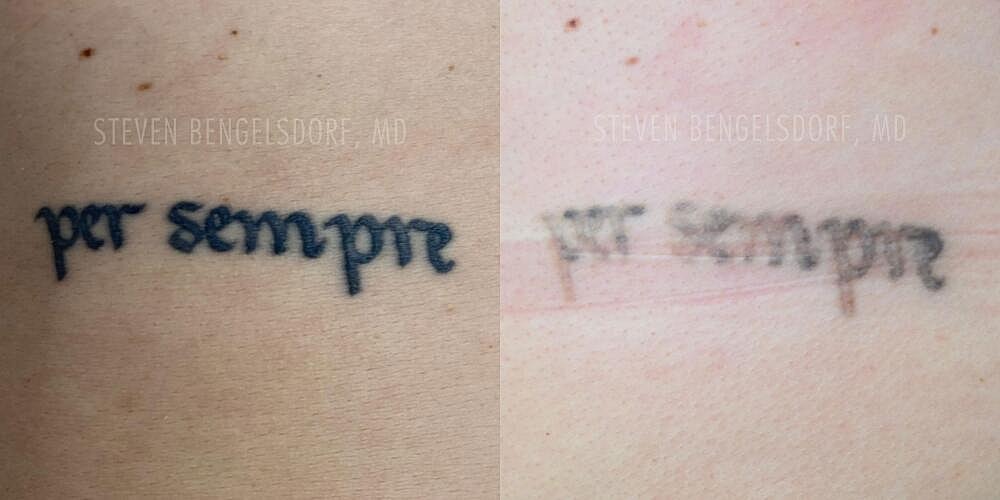 Tattoo Removal Before & After Image