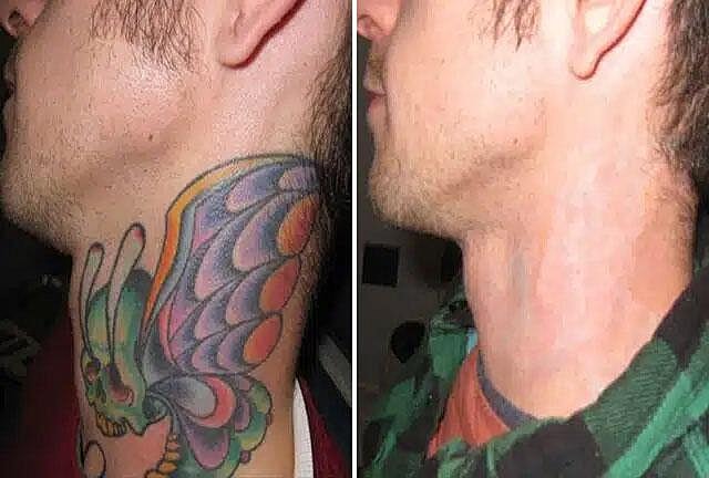 Tattoo Removal Before & After Image