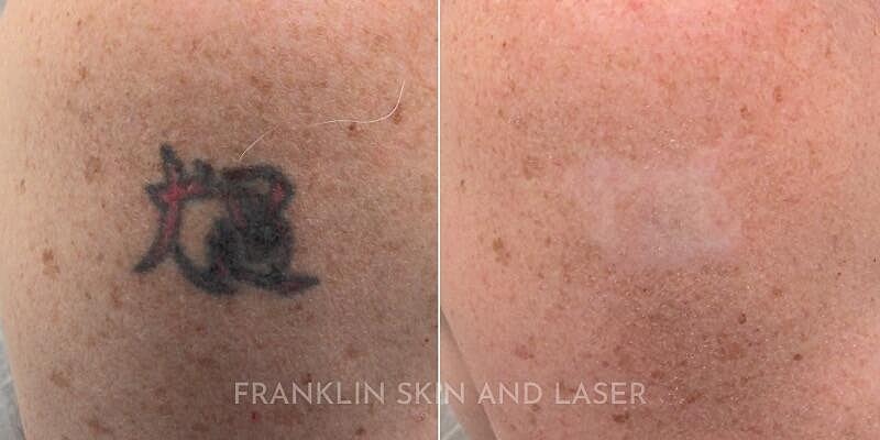 Tattoo Removal Before & After Image