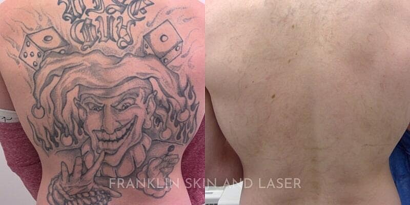 Tattoo Removal Before & After Image