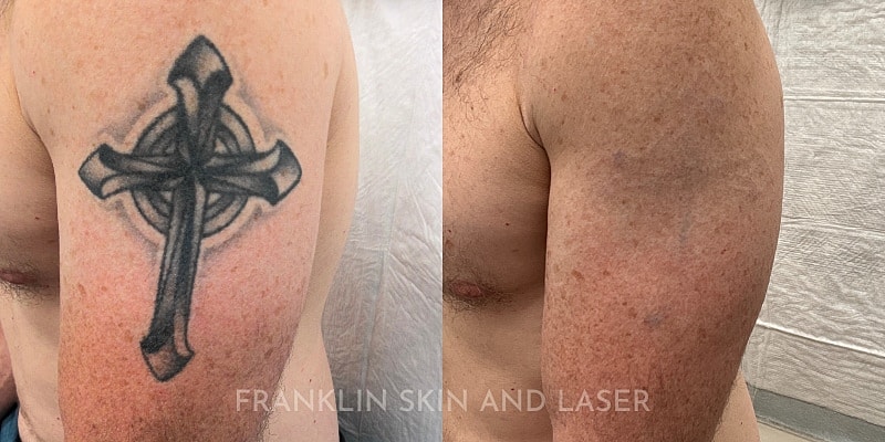 Tattoo Removal Before & After Image