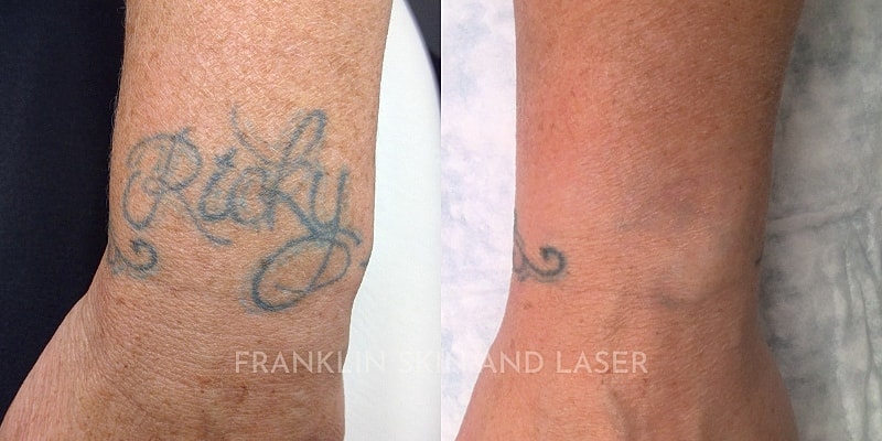 Tattoo Removal Before & After Image