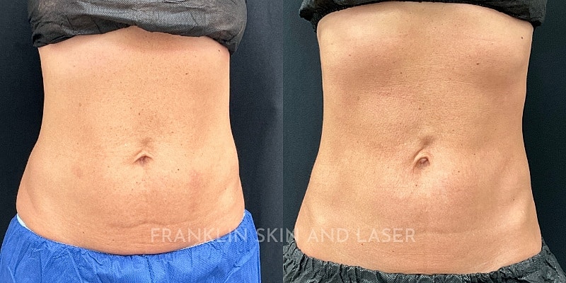 Morpheus8 Body Before & After Image