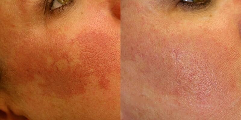 Birthmark Removal Before & After Image