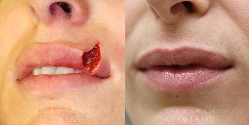 Scar Revision Before & After Image