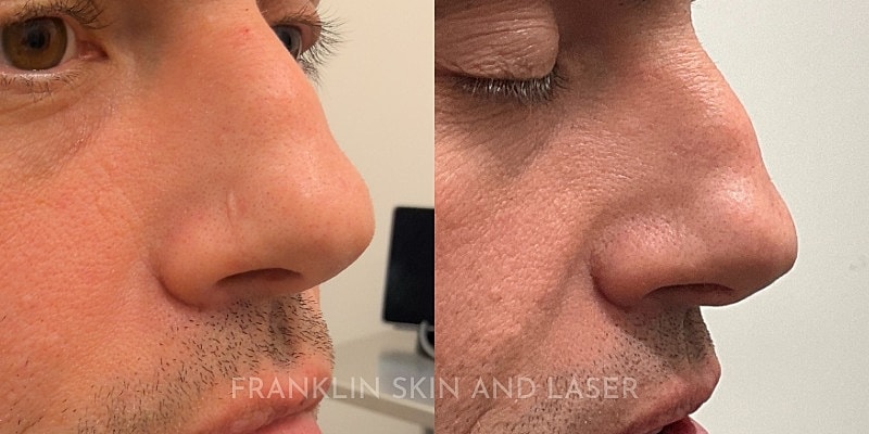 Scar Revision Before & After Image