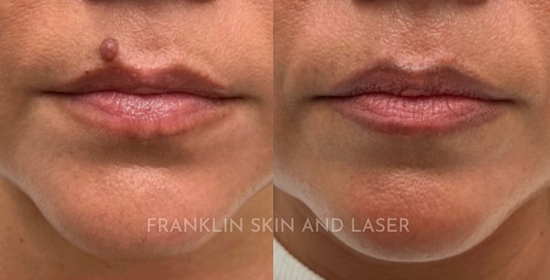 CO2 Laser Resurfacing Before & After Image