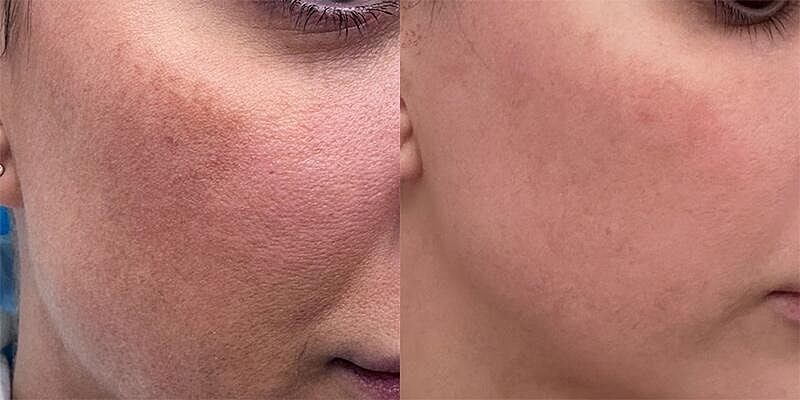 UltraClear Before & After Image