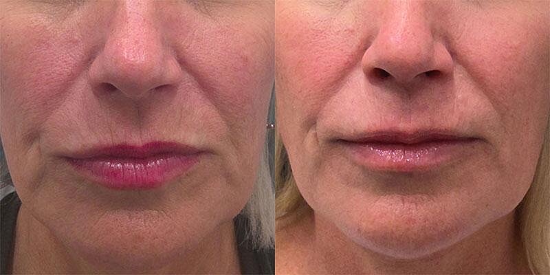 UltraClear Before & After Image