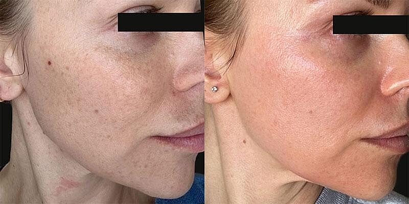 UltraClear Before & After Image