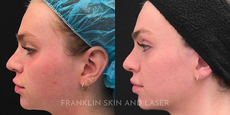 UltraClear Before & After Image