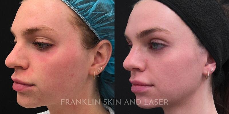 UltraClear Before & After Image